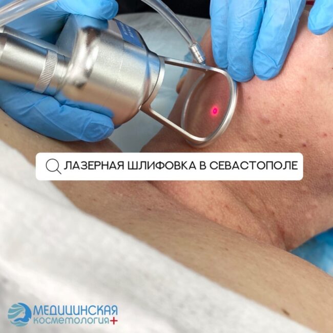 lazernaya-shlifovka лазерная шлифовка кожи в Севастополе