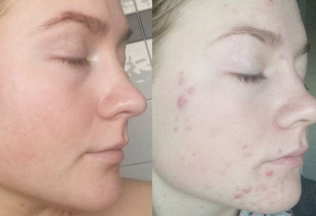 Acne-Results-woman